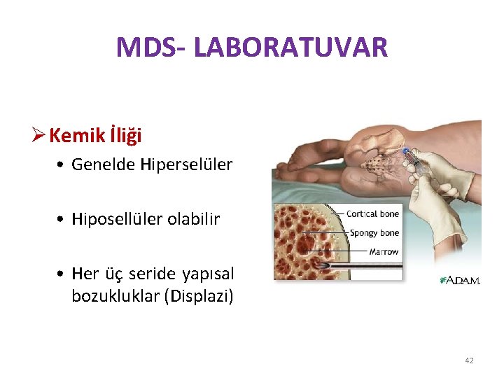 MDS- LABORATUVAR Ø Kemik İliği • Genelde Hiperselüler • Hiposellüler olabilir • Her üç