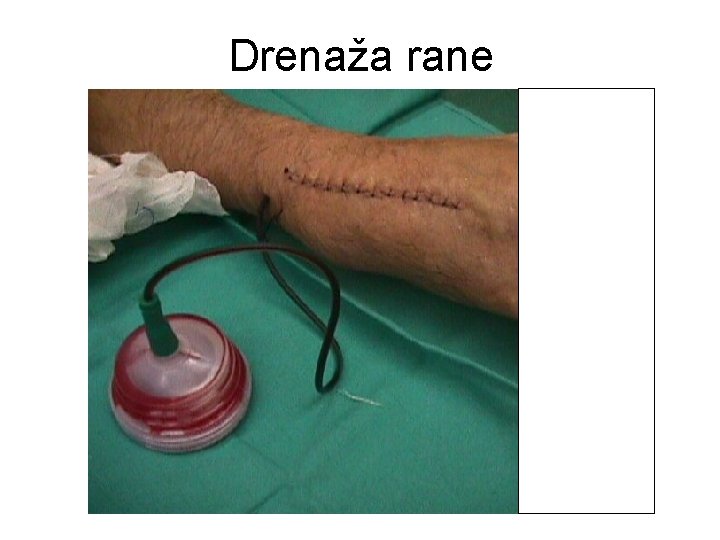 Drenaža rane Drenaža rane