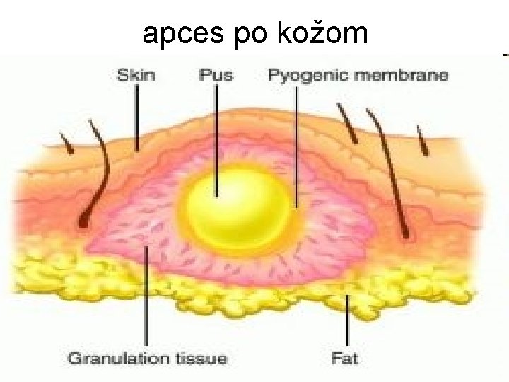 apces po kožom 