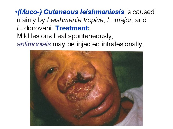  • (Muco-) Cutaneous leishmaniasis is caused mainly by Leishmania tropica, L. major, and