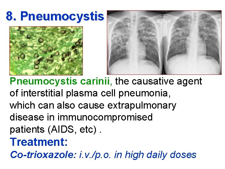 8. Pneumocystis carinii, the causative agent of interstitial plasma cell pneumonia, which can also