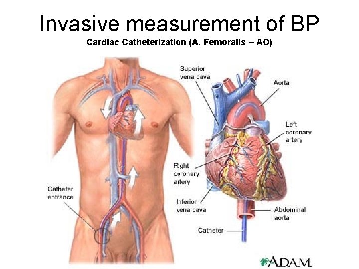 Invasive measurement of BP Cardiac Catheterization (A. Femoralis – AO) 