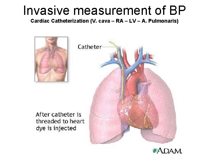 Invasive measurement of BP Cardiac Catheterization (V. cava – RA – LV – A.