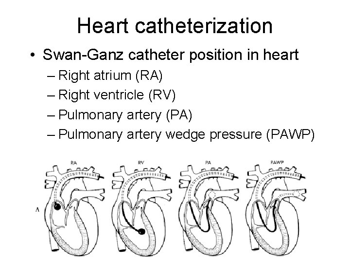 Heart catheterization • Swan-Ganz catheter position in heart – Right atrium (RA) – Right
