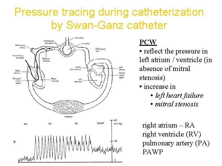 Pressure tracing during catheterization by Swan-Ganz catheter PCW • reflect the pressure in left