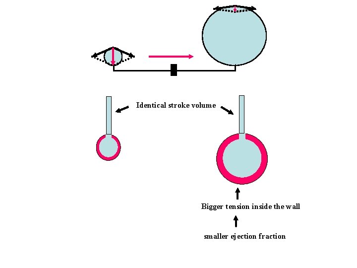 Identical stroke volume Bigger tension inside the wall smaller ejection fraction 