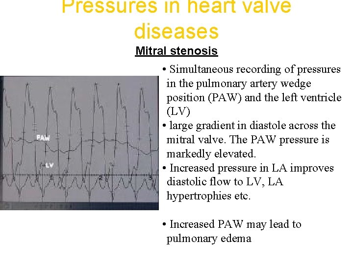 Pressures in heart valve diseases Mitral stenosis • Simultaneous recording of pressures in the