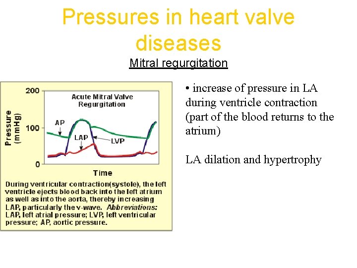 Pressures in heart valve diseases Mitral regurgitation • increase of pressure in LA during