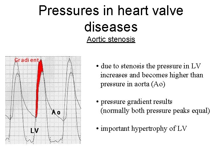 Pressures in heart valve diseases Aortic stenosis • due to stenosis the pressure in