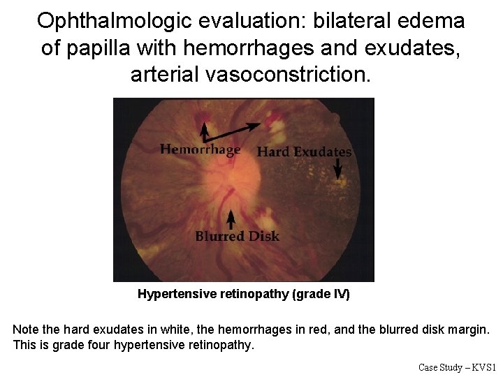 Ophthalmologic evaluation: bilateral edema of papilla with hemorrhages and exudates, arterial vasoconstriction. Hypertensive retinopathy