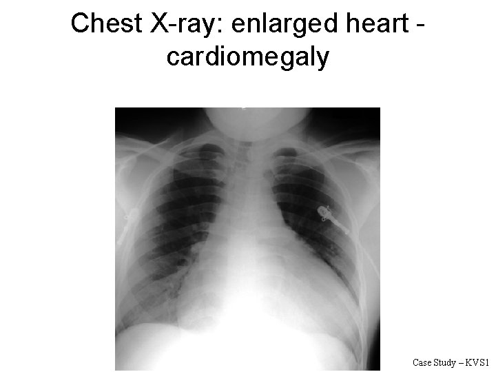 Chest X-ray: enlarged heart - cardiomegaly Case Study – KVS 1 