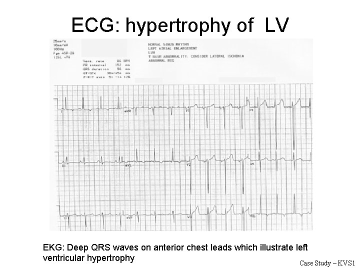 ECG: hypertrophy of LV EKG: Deep QRS waves on anterior chest leads which illustrate