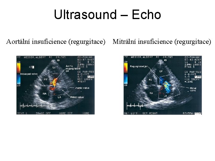 Ultrasound – Echo Aortální insuficience (regurgitace) Mitrální insuficience (regurgitace) 