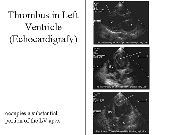 Thrombus in Left Ventricle (Echocardigrafy) occupies a substantial portion of the LV apex 
