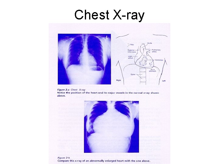 Chest X-ray 