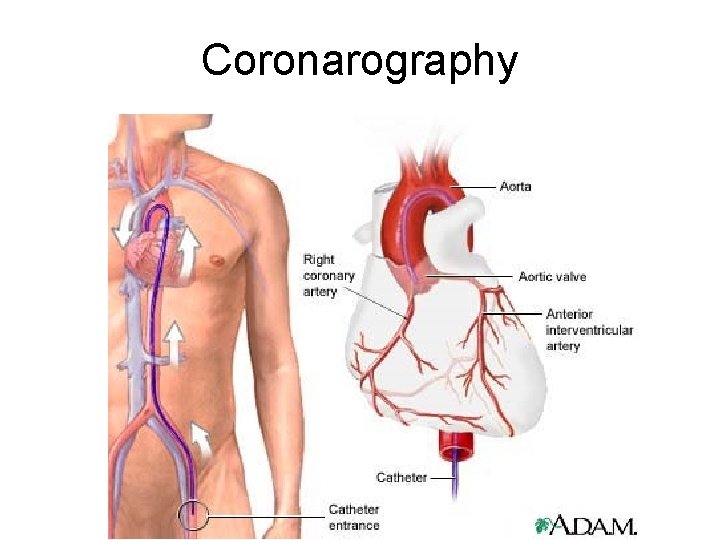 Coronarography 