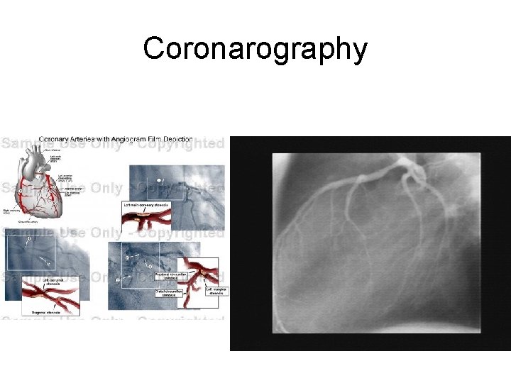 Coronarography 