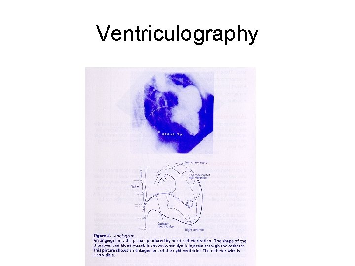 Ventriculography 