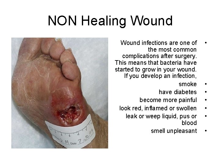 NON Healing Wound infections are one of the most common complications after surgery. This