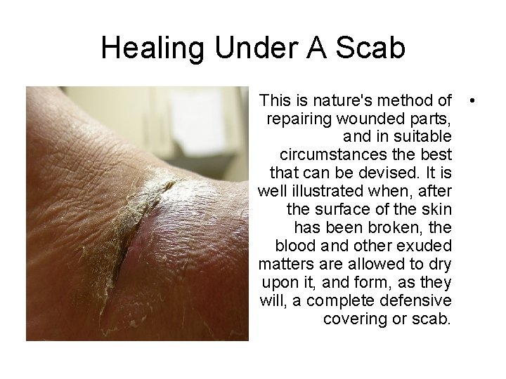  Healing Under A Scab This is nature's method of • repairing wounded parts,