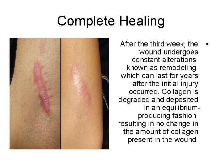 Complete Healing After the third week, the • wound undergoes constant alterations, known as