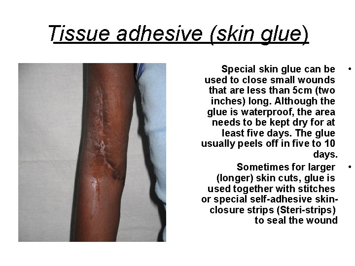 Tissue adhesive (skin glue) Special skin glue can be • used to close small