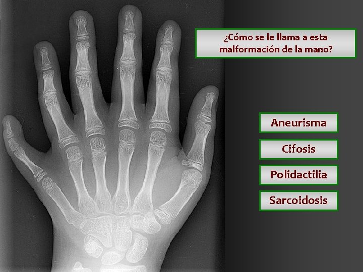 ¿Cómo se le llama a esta malformación de la mano? Aneurisma Cifosis Polidactilia Sarcoidosis ¿Cómo se le llama a esta malformación de la mano? Aneurisma Cifosis Polidactilia Sarcoidosis