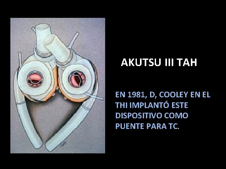 AKUTSU III TAH EN 1981, D, COOLEY EN EL THI IMPLANTÓ ESTE DISPOSITIVO COMO