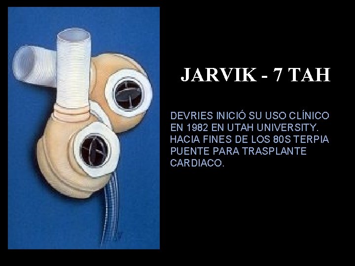 JARVIK - 7 TAH DEVRIES INICIÓ SU USO CLÍNICO EN 1982 EN UTAH UNIVERSITY.