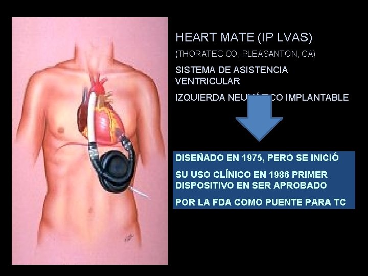 HEART MATE (IP LVAS) (THORATEC CO, PLEASANTON, CA) SISTEMA DE ASISTENCIA VENTRICULAR IZQUIERDA NEUMÁTICO