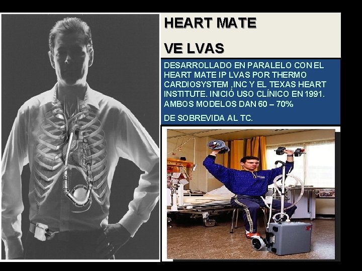 HEART MATE VE LVAS DESARROLLADO EN PARALELO CON EL HEART MATE IP LVAS POR