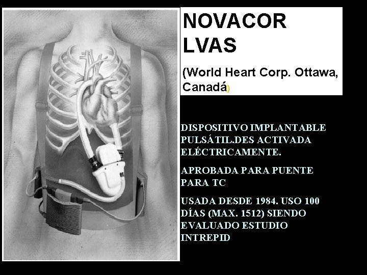 NOVACOR LVAS (World Heart Corp. Ottawa, Canadá) DISPOSITIVO IMPLANTABLE PULSÁTIL. DES ACTIVADA ELÉCTRICAMENTE. APROBADA