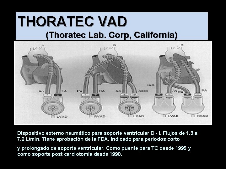 THORATEC VAD (Thoratec Lab. Corp, California) Dispositivo externo neumático para soporte ventricular D -