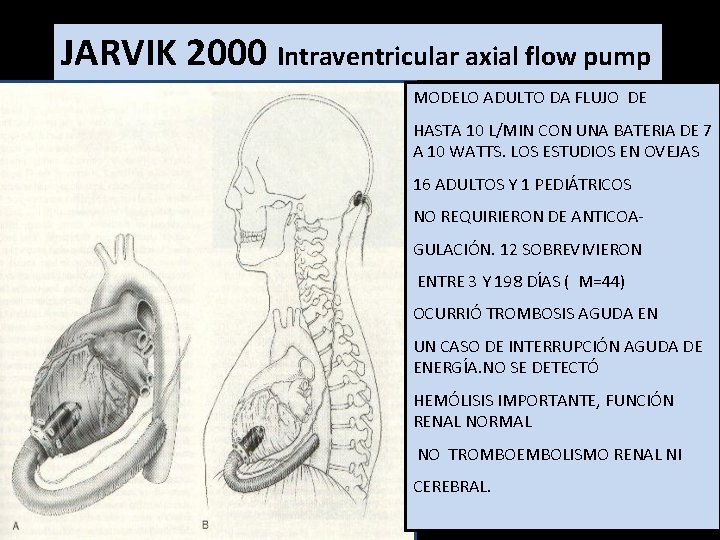 JARVIK 2000 Intraventricular axial flow pump MODELO ADULTO DA FLUJO DE HASTA 10 L/MIN