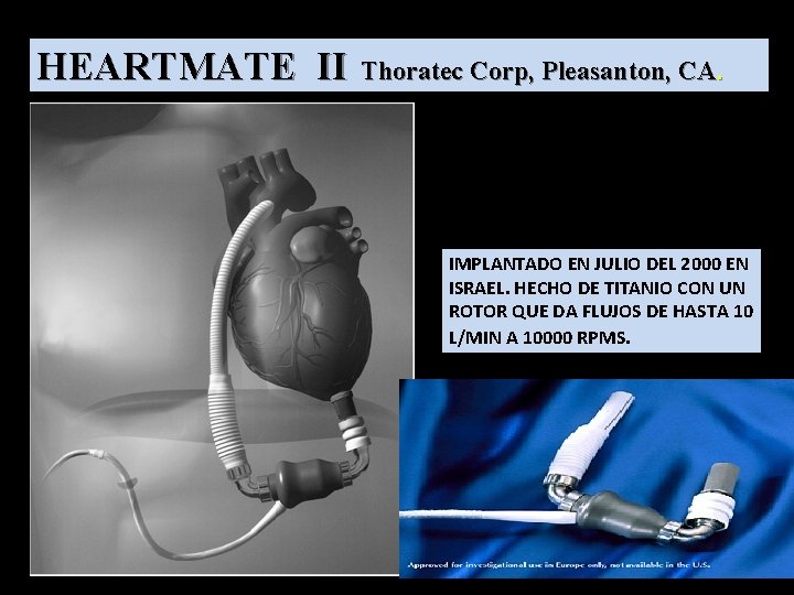 HEARTMATE II Thoratec Corp, Pleasanton, CA. IMPLANTADO EN JULIO DEL 2000 EN ISRAEL. HECHO