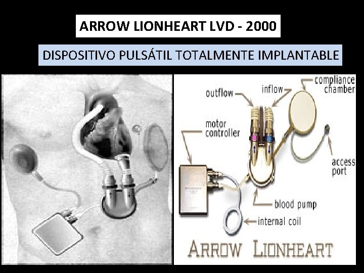 ARROW LIONHEART LVD - 2000 DISPOSITIVO PULSÁTIL TOTALMENTE IMPLANTABLE 
