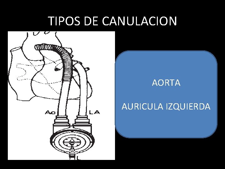 TIPOS DE CANULACION AORTA AURICULA IZQUIERDA 