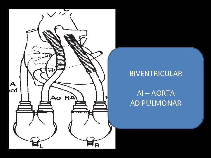 BIVENTRICULAR AI – AORTA AD PULMONAR 