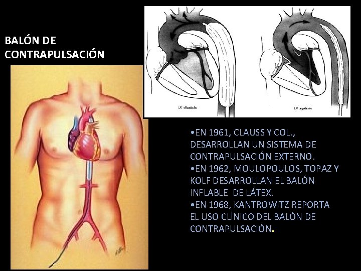 BALÓN DE CONTRAPULSACIÓN • EN 1961, CLAUSS Y COL. , DESARROLLAN UN SISTEMA DE