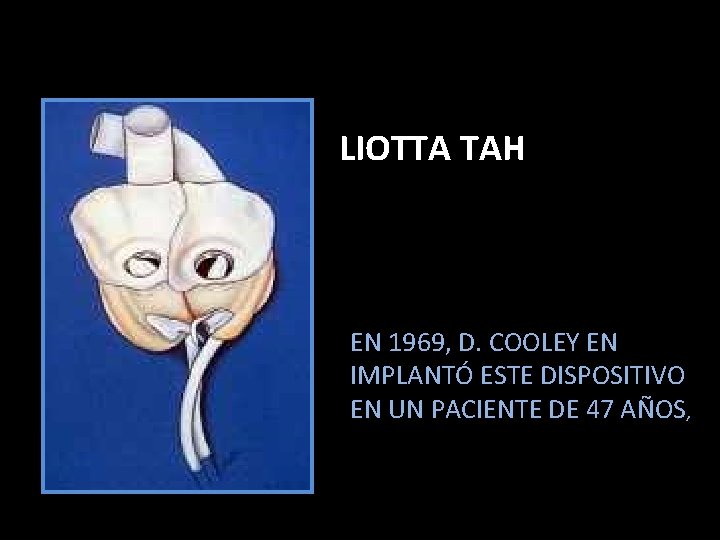 LIOTTA TAH EN 1969, D. COOLEY EN IMPLANTÓ ESTE DISPOSITIVO EN UN PACIENTE DE