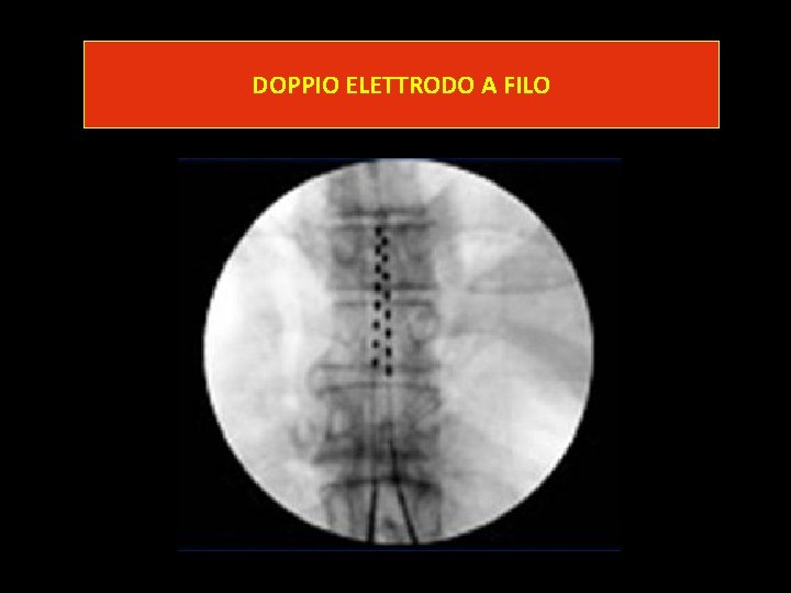 DOPPIO ELETTRODO A FILO DOPPIO ELETTRODO A FILO