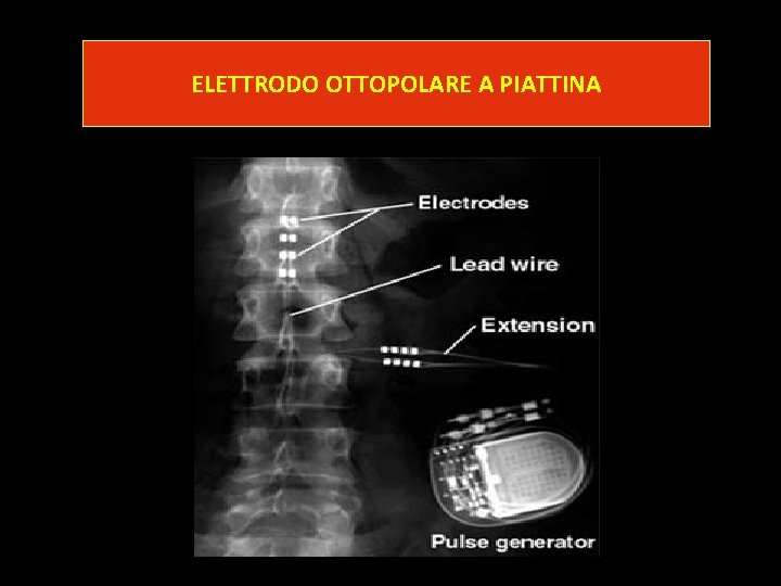 ELETTRODO OTTOPOLARE A PIATTINA ELETTRODO OTTOPOLARE A PIATTINA