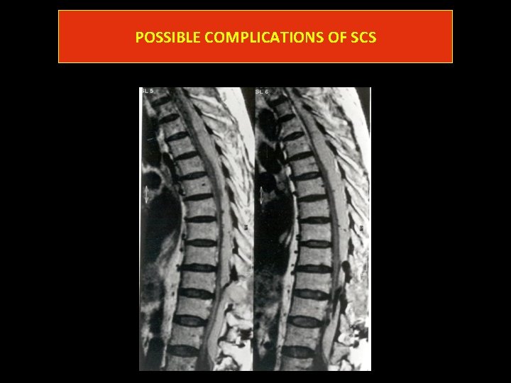 POSSIBLE COMPLICATIONS OF SCS POSSIBLE COMPLICATIONS OF SCS