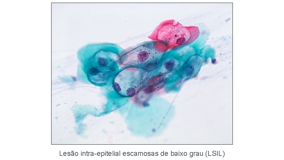 Lesão intra-epitelial escamosas de baixo grau (LSIL) 