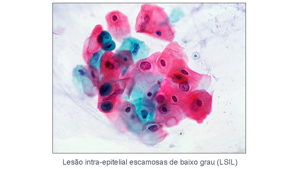 Lesão intra-epitelial escamosas de baixo grau (LSIL) 