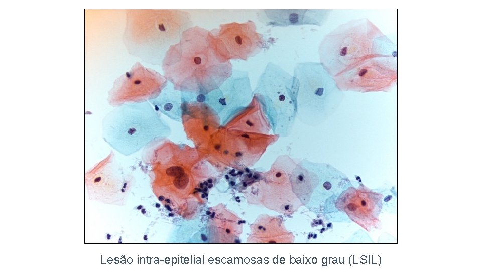 Lesão intra-epitelial escamosas de baixo grau (LSIL) 