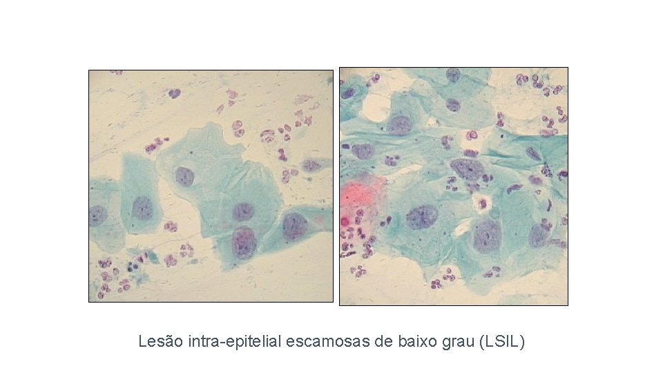 Lesão intra-epitelial escamosas de baixo grau (LSIL) 