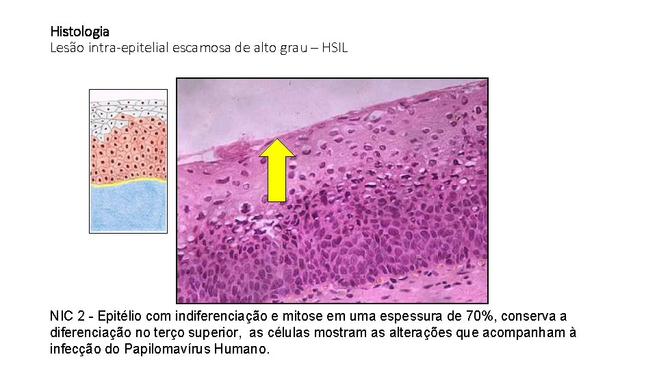 Histologia Lesão intra-epitelial escamosa de alto grau – HSIL NIC 2 - Epitélio com