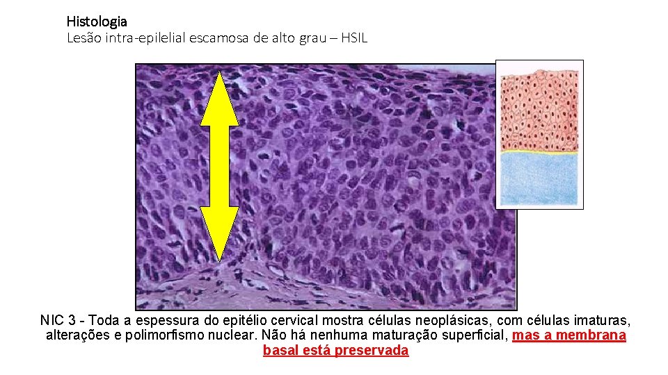 Histologia Lesão intra-epilelial escamosa de alto grau – HSIL NIC 3 - Toda a