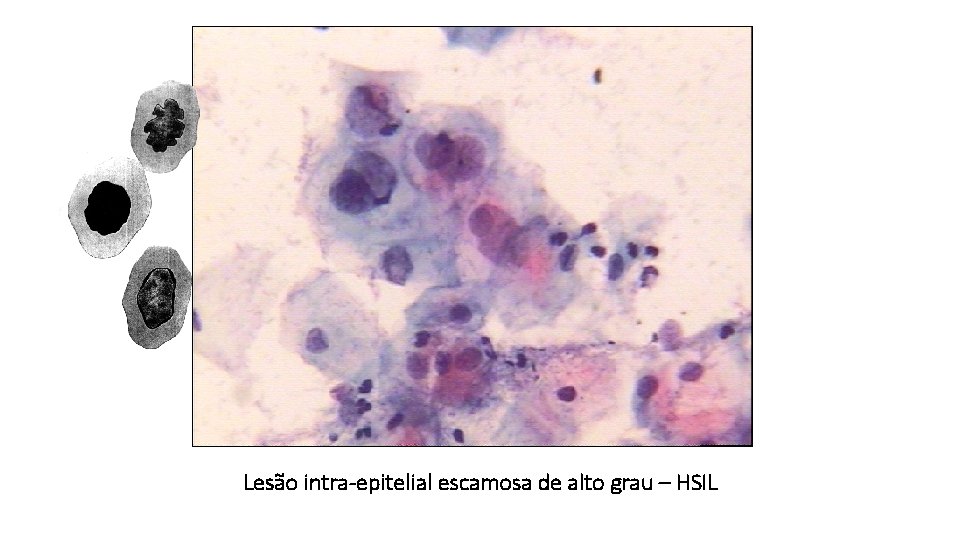 Lesão intra-epitelial escamosa de alto grau – HSIL 